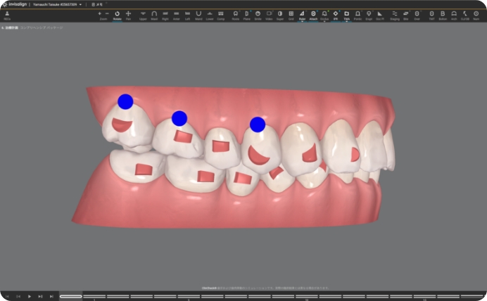 デジタル矯正システム