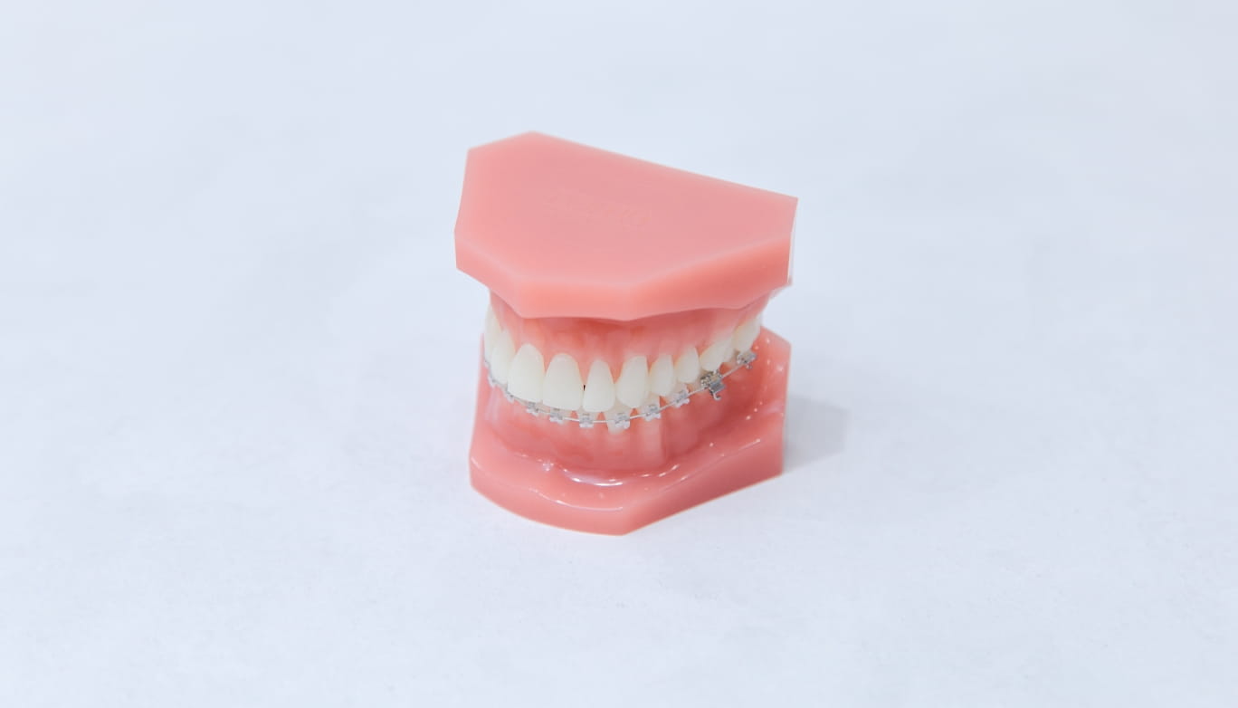 ハーフリンガル矯正