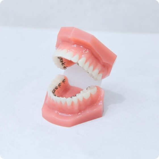 裏側矯正（リンガル矯正）